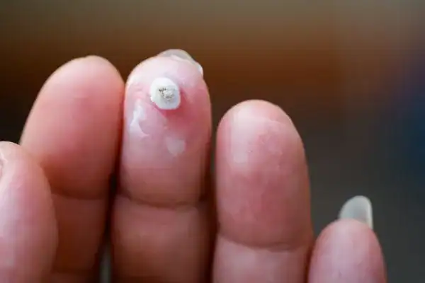 Image of white wart before cryopen treatment Isleworth