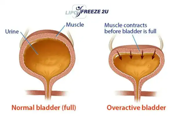 diagram of overactive bladder treatment Isleworth