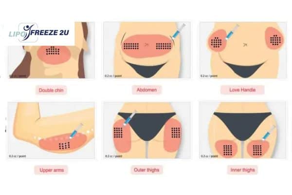 Benefits of Choosing Aqualyx for Fat Reduction Isleworth
