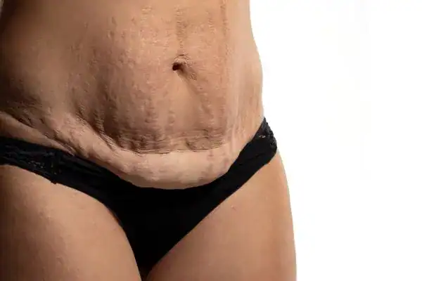 loose skin after weight loss injections Isleworth