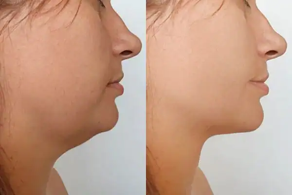 Fat dissolving injections results Isleworth