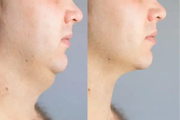 Fat dissolving injections results Isleworth