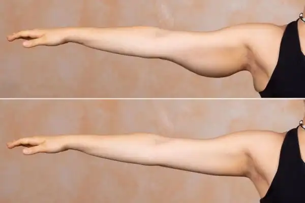 Results on the arms of fat dissolving injections Isleworth