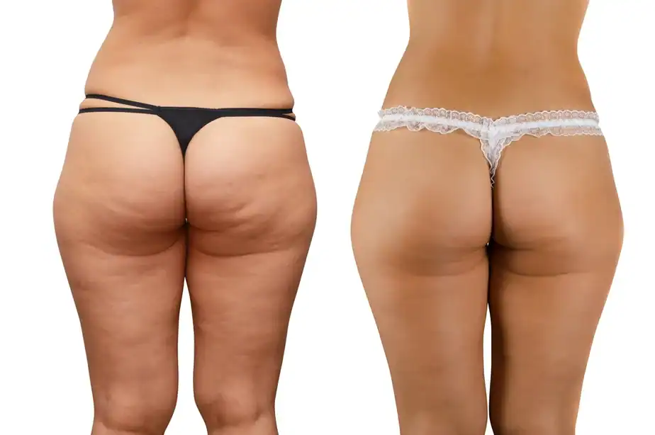 Before and after cellulite treatment Isleworth results.