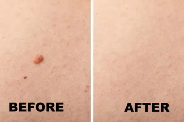 mole removal results before and after Cryopen Cryotherapy Treatment Isleworth