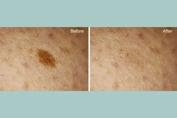 Before and after age spot removal following Cryopen Cryotherapy Treatment Isleworth