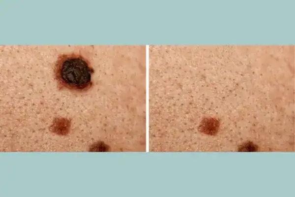 Before and after results from Cryopen Cryotherapy Treatment Isleworth