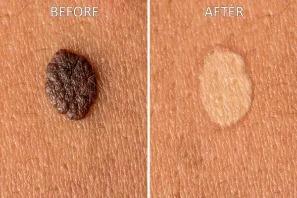 Wart removal results before and after Cryopen Cryotherapy Treatment Isleworth