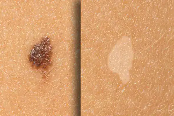 Before and after results Cryopen Cryotherapy Treatment Isleworth