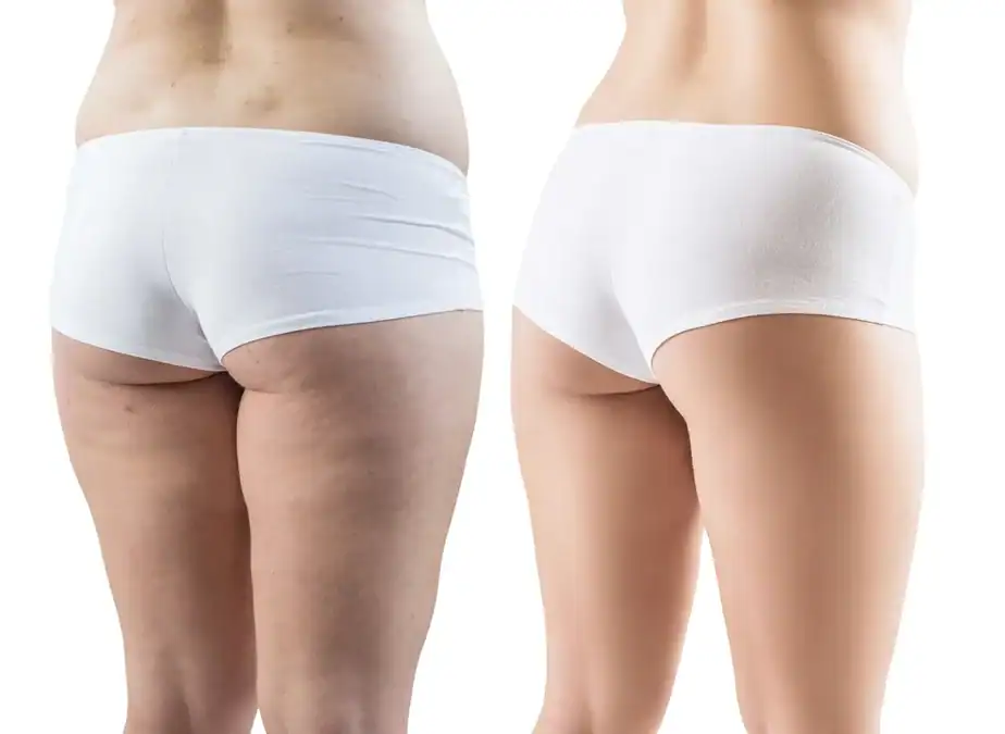 before and after Inner thighs toning treatment Isleworth results
