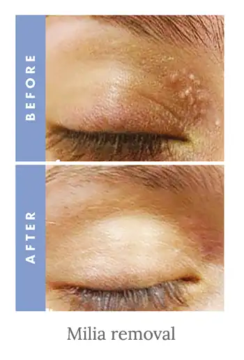 Before and after results of milia removal treatment Isleworth.