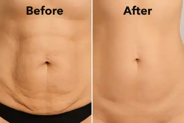 before and after body toning treatment Isleworth