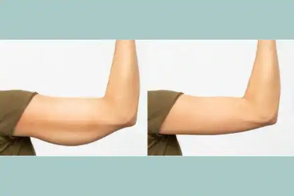 Before and after results of arm toning treatment Isleworth