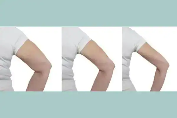 before and after results of arm toning treatment Isleworth