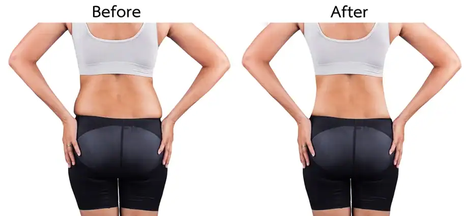 Before & After back toning treatment Isleworth