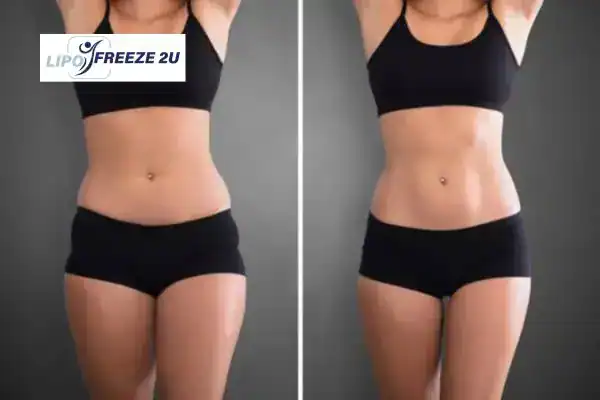 How Can LIPO FREEZE 2U Support Your Post-Pregnancy Body Recovery Isleworth?