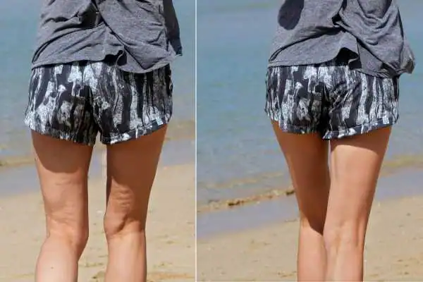 before and after results of cellulite treatment Isleworth