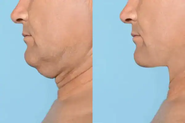 mans before and after chin toning treatment Isleworth results.