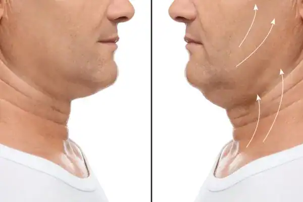 Before and after chin toning treatment Isleworth results.