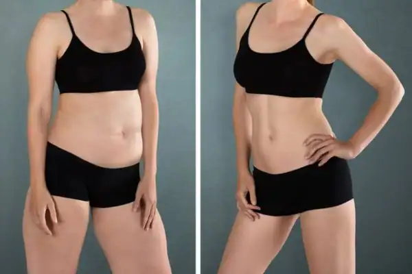 Before and after hip toning treatment Isleworth
