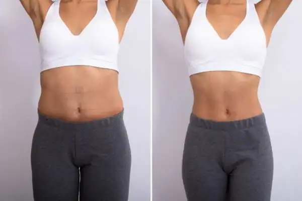 Before and after results of Hip toning treatment Isleworth