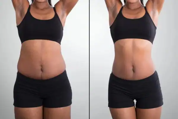 before and after hip toning treatment Isleworth