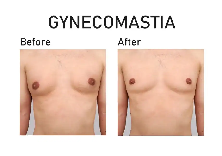 before and after man boobs treatment Isleworth