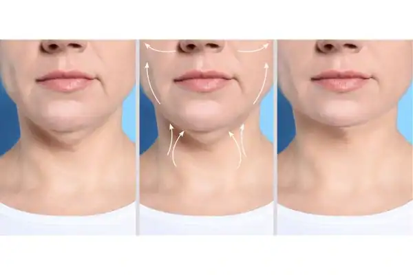womans result of neck toning treatment Isleworth