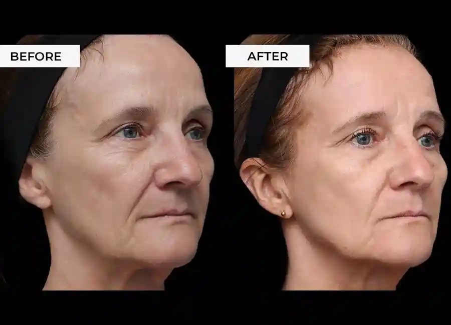 How Many RF Microneedling Sessions Will You Need to See a Difference Isleworth?